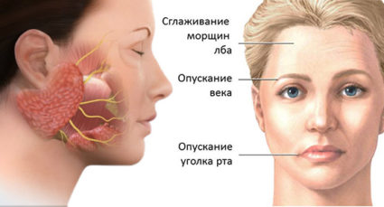 Невралгия на лицевия нерв - как да се идентифицират и лекуват?