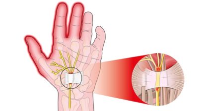 Изтръпването на пръстена на пръстена и малкия пръст на лявата ръка са причинени от централната нервна система