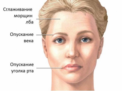 Симптоми и лечение на невралгия на лицевия нерв