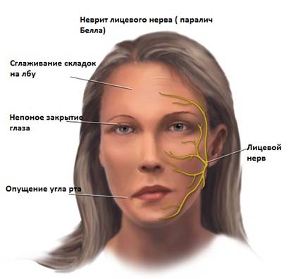 Причини и лечение на неврит на лицевия нерв