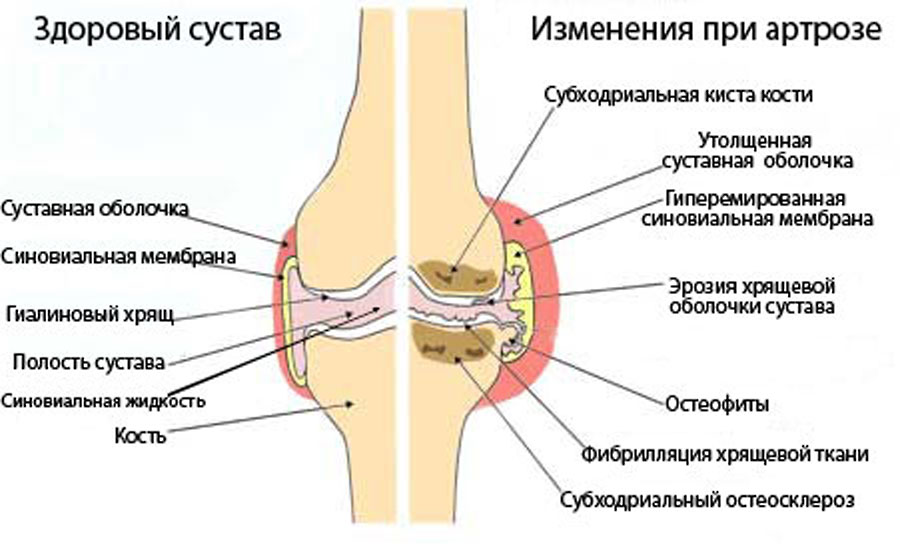 Причини, симптоми и лечение на артроза на коляното