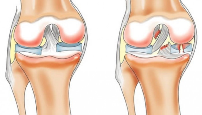 Увреждане на кръстосаните връзки на колянната става