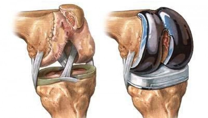 Степени и лечение на ганартроза на колянната става