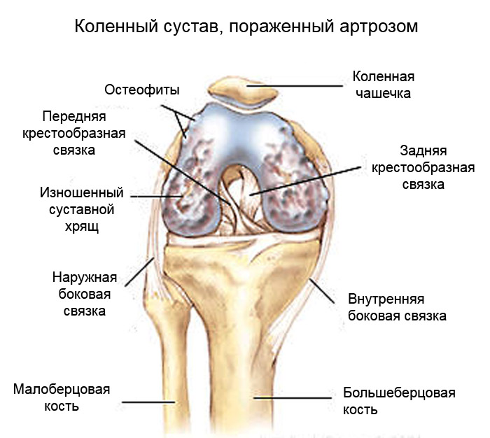 Как да се лекува остеоартрит на колянната става?