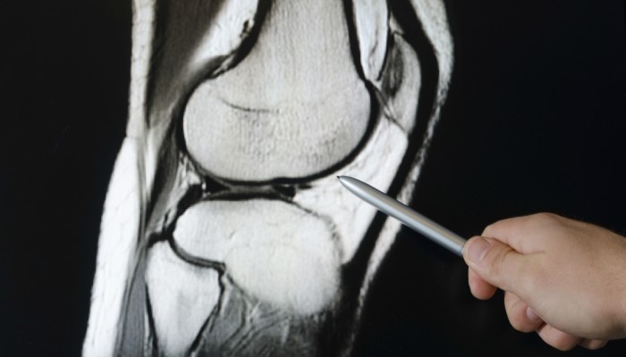 Увреждания на менискусите на колянната става: причини, симптоми и терапия