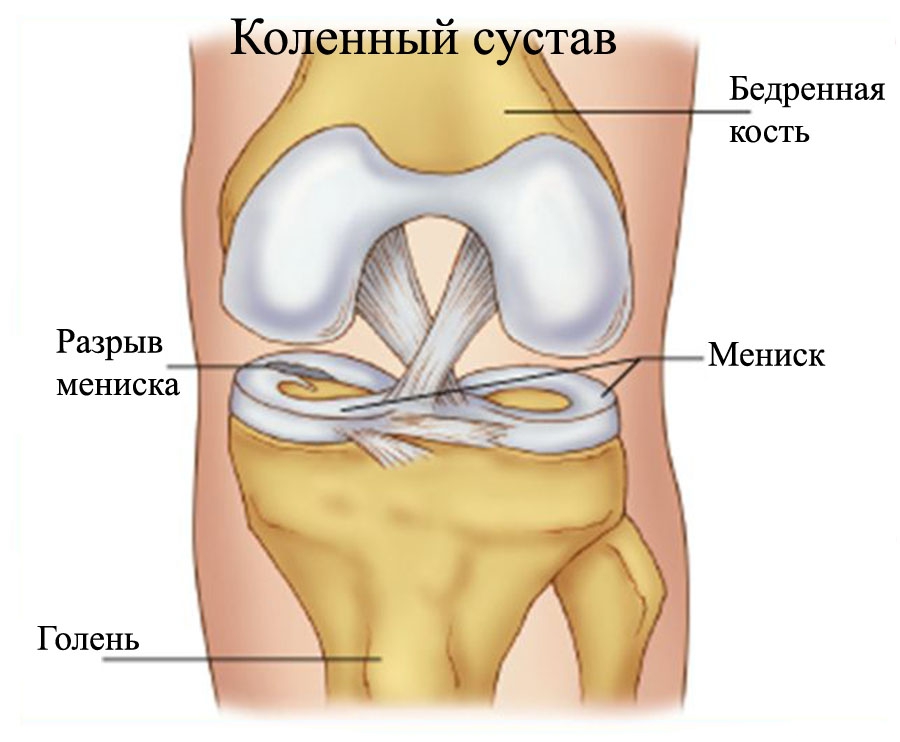 Увреждания на менискусите на колянната става: причини, симптоми и терапия