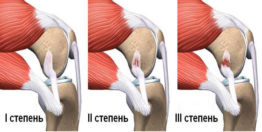 Разкъсване на сухожилията на колянната става: лечение и условия за рехабилитация