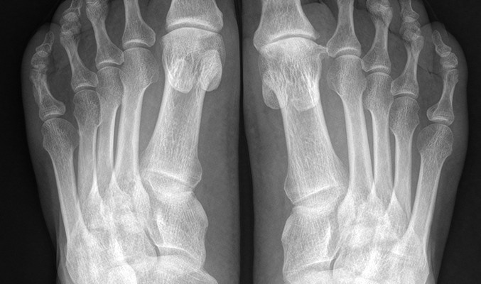 Симптоми и лечение на артроза на пръстите на краката