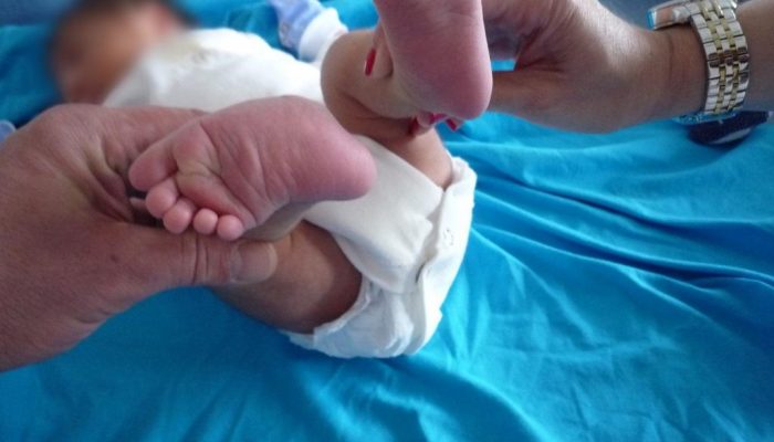 Valgus Foot in the Child: Причини и лечение