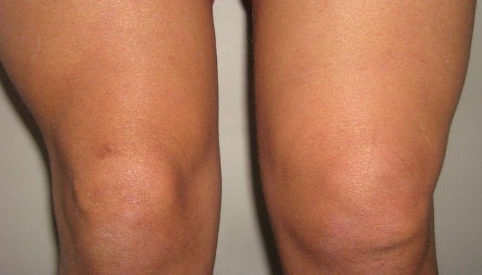 Остър и хроничен синовит на колянната става: лечение