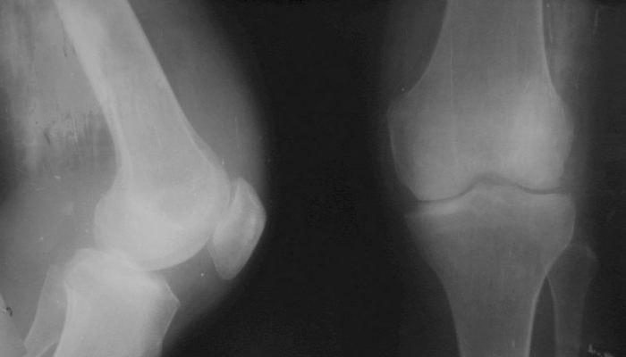 Остър и хроничен синовит на колянната става: лечение