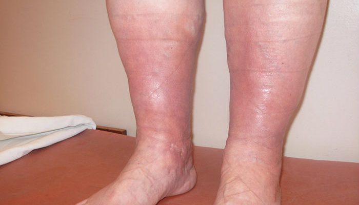 Причини за подуване на краката под коляното