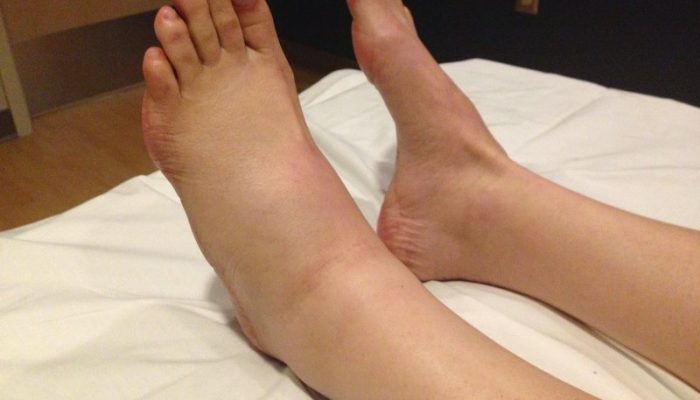 Причини за подуване на краката под коляното