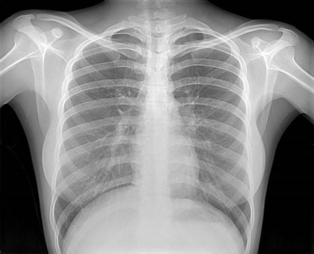 Рентгенография на гръдния кош: кои патологии на органите могат да бъдат определени чрез изследване