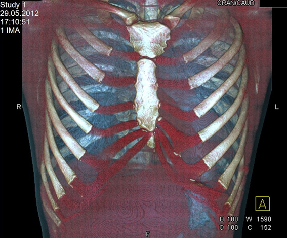 Как и за каква е компютърната томография (СТ) сканиране на гръдните органи