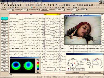Какво показва ЕЕГ процедурата на мозъка при деца и възрастни, тълкуването на резултатите