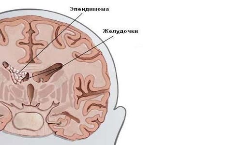 Характеристики на диагнозата и лечението, прогнозата и оцеляването в анапластичния епендимом на мозъка и гръбначния мозък