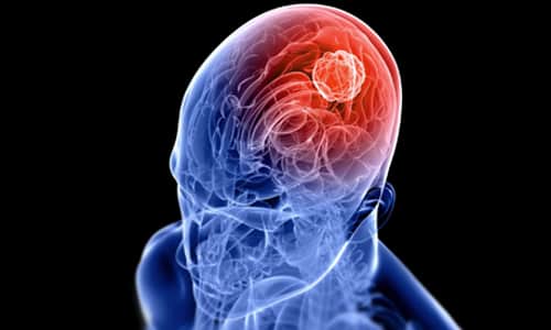 Видове, симптоми, лечение и прогноза за астроцитома на мозъка
