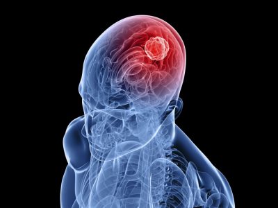 Чести симптоми, лечение и ранни признаци на ранен мозъчен тумор