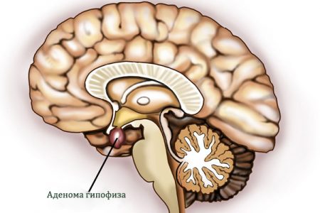Симптоми, лечение и последствия от аденома на хипофизната жлеза на мозъка