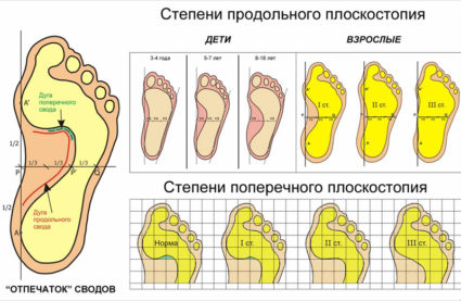 Как да изберем ортопедични обувки за валгус на стъпалата?