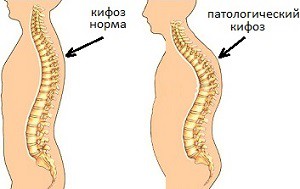 Изкривяването на гръбначния стълб и ъгълът на кифозата са важни нюанси