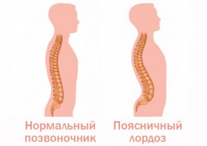 Хиперлодоза на лумбалната част на гръбначния стълб: симптоми, причини, лечение