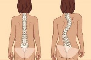 Корсет - решение на проблема с кривината на гръбначния стълб