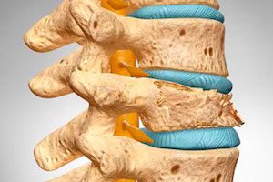 Какво трябва да бъде корсетът при лечението на остеопороза
