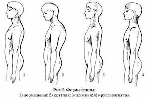 Корекция на синдрома на плосък гръб
