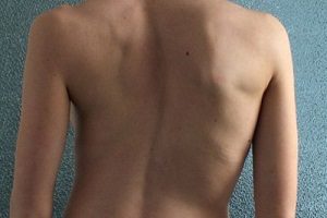 Какви упражнения за гърба ще помогнат със сколиозата