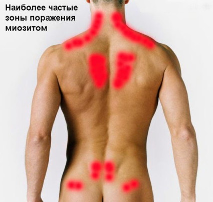 Остър и хроничен миозит на мускулите на гърба