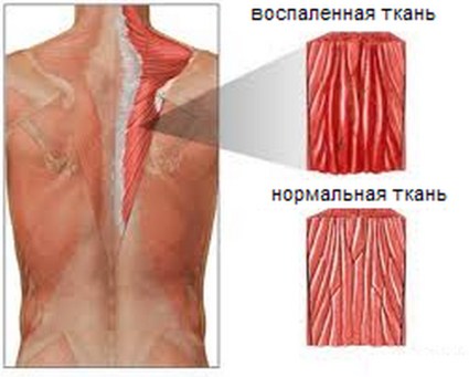 Остър и хроничен миозит на мускулите на гърба