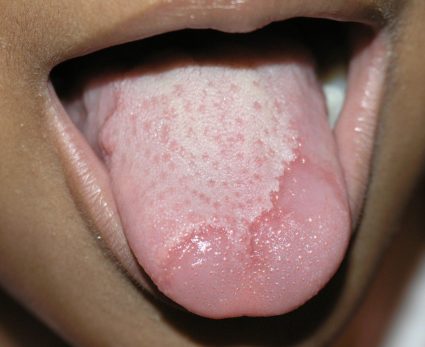 Какъв е глоситът на езика и как да се лекува?