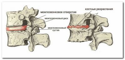 Хондроза на гръбначния гръбначен стълб