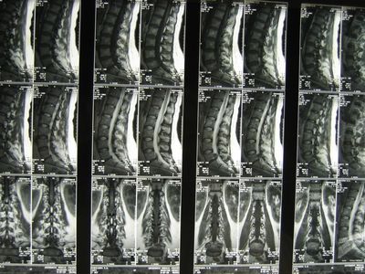 Диагноза на гръдната цервикална остеохондроза