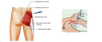 Инжекции в цервикса на гръбначния стълб