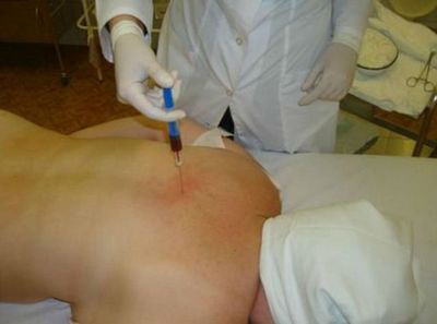 Инжекции с остеохондроза на цервикалния гръбначен стълб