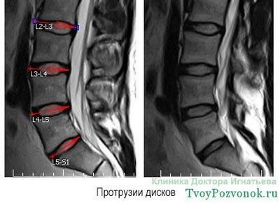 Остеохондроза на цервикалния гръбнак с изпъкналости на дисковете