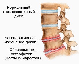 Препарати за остеохондроза на гръбначния стълб