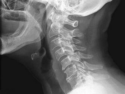 Спондилоза на цервикалния гръбначен стълб