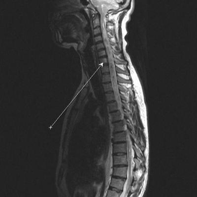 Сиригенемия на цервикалния и гръдния гръбнак