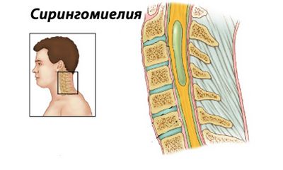 Сиригенемия на цервикалния и гръдния гръбнак