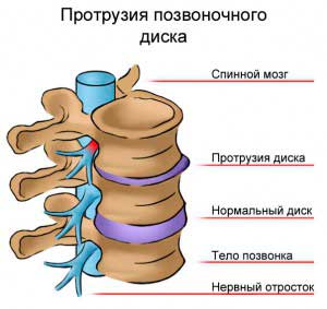 Изпъкналостта на гръбначния стълб е