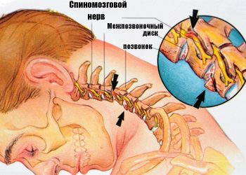 Лечение на нервно нахлуване в цервикалната област