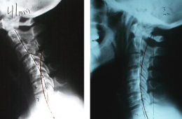Какво представлява нарушението на статиката на гръбначния стълб?