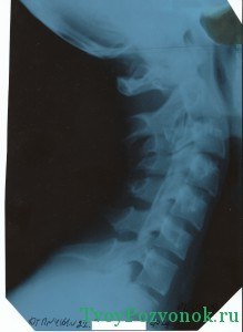 Рентгеново изследване на цервикалния гръбнак с функционални тестове
