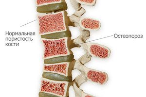 Как да отговоря на въпроса, дали остеопорозата и остеохондрозата се различават