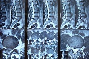 MRI за остеохондроза: индикации, предимства и процедура за процедурата