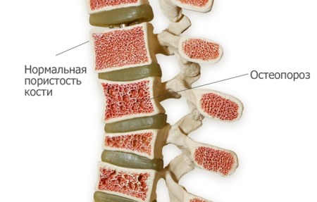 Причини, симптоми и мерки за предотвратяване на дифузна остеопороза на гръбначния стълб